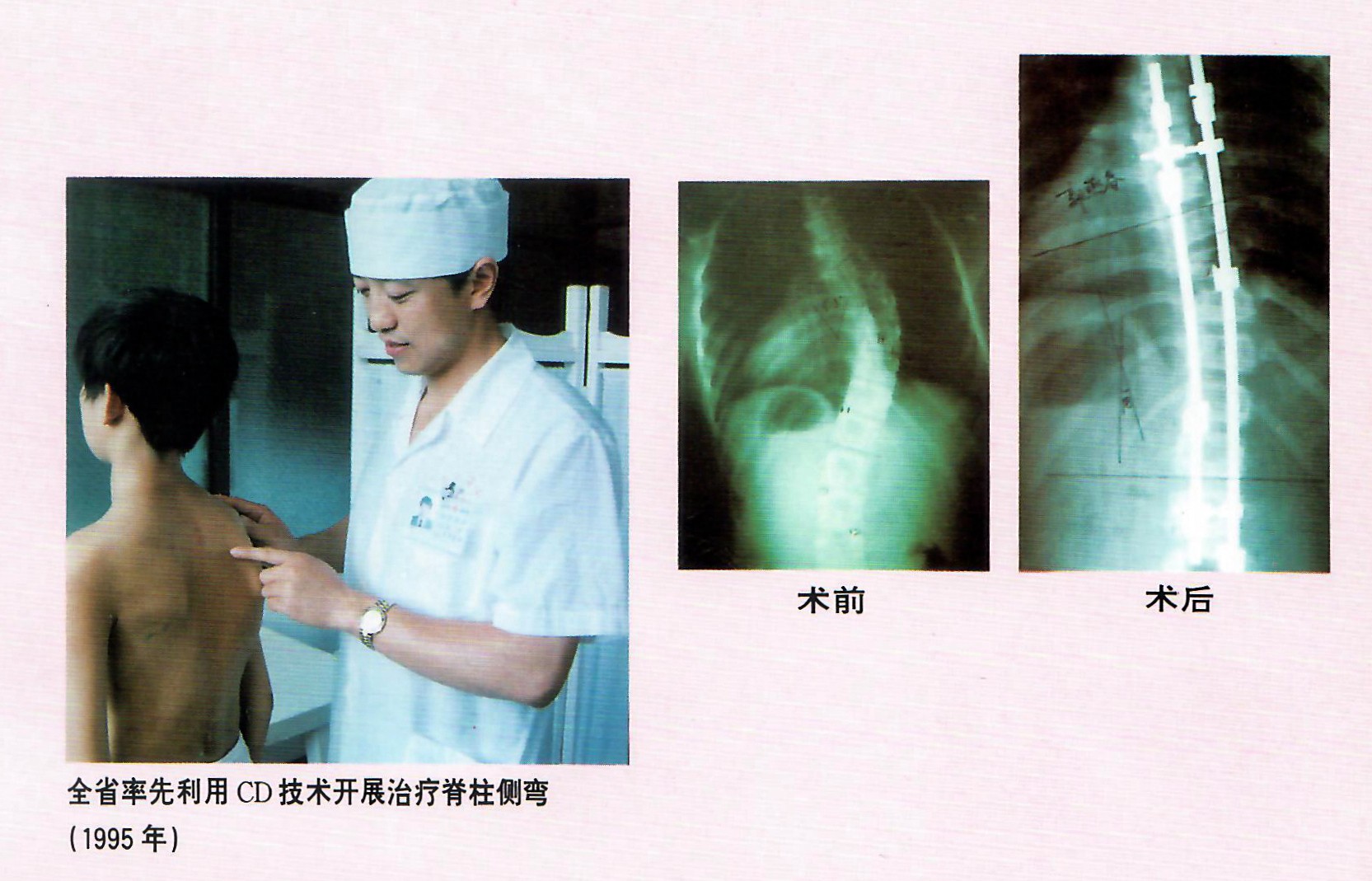 1995年，林海濱教授做了福建省第一例CD技術(shù)矯正脊椎側(cè)彎手術(shù).jpg